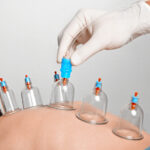 Cupping Therapy PTR