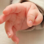Congenital Hand Differences