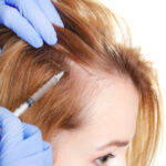Hair Transplantation in Women